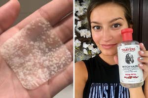 Close-up of hand holding a hydrocolloid acne patch; a woman holds Thayers Rose Petal Witch Hazel Toner, appearing happy with her skincare product