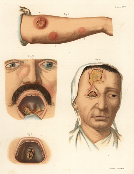 Medical illustrations showing symptoms of what might be an infection on a person&#x27;s arm, mouth, and face