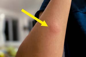 A close-up of a person's arm showing a raised, reddish bump on the skin, likely indicating an insect bite or allergic reaction. No further context provided